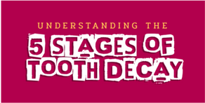 UNDERSTANDING THE FIVE STAGES OF TOOTH DECAY