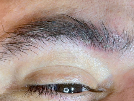 Falhas nas sobrancelhas: pode ser culpa da caspa