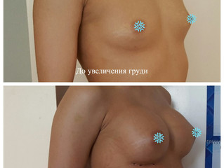 Зачем женщина увеличивает грудь?