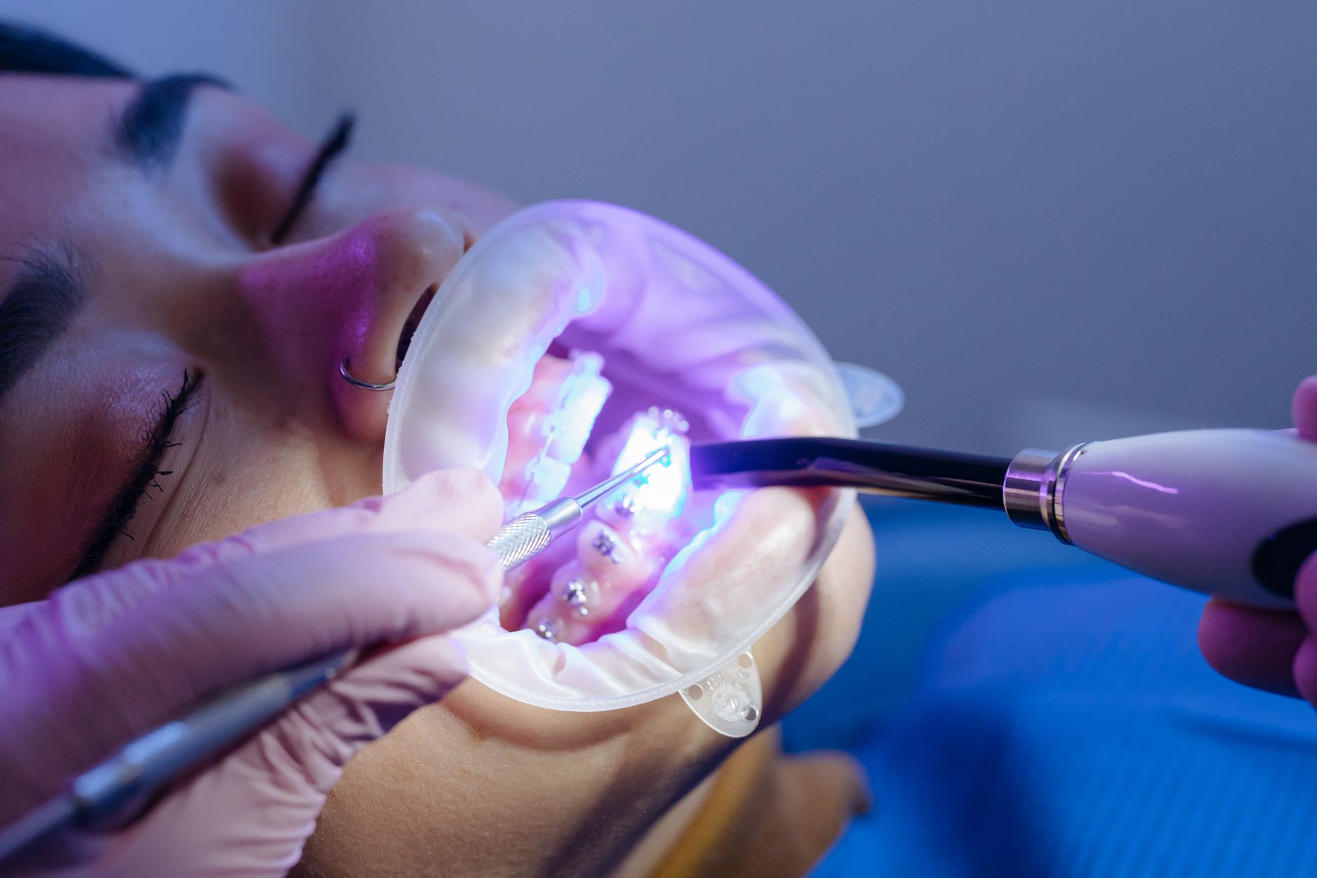 Nightguard or Mouthguard: What's the Difference and Which One Do You Actually Need?
