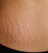 Stretch marks 