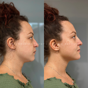 Preenchimento de mento e malar 