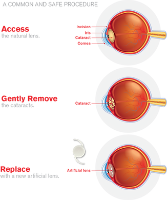 Cataract_Surgery_Process_Image_04 (1).pn