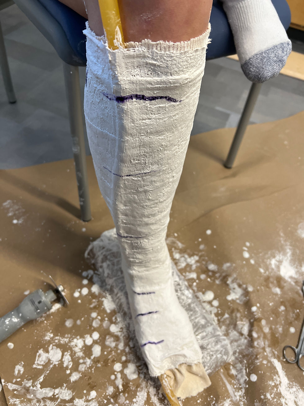 Dried plaster, ready to cut it off the patient's leg