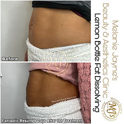 lemon bottle fat dissolving nyc ✨ Let's talk Lemon Bottle Fat Dissolving under the chin… This treatment is  a natural way to define your facial structure, sculpt your lower face, and  melt away stubborn fat — all main image 1