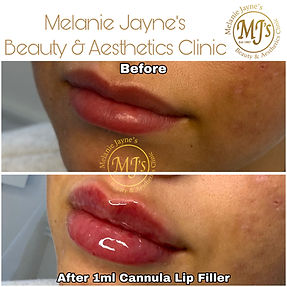 Cannula Lip Filler.JPEG