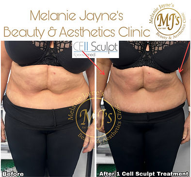 Cell sculpt Fat Dissolving Cavitation.JPEG
