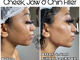 Jaw, Cheek and Chin Filler.JPEG