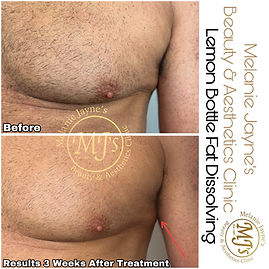 Pseudo-Gynecomastia (man Boobs) fat dissolving.JPEG