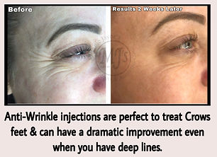 Botox Crows Feet.jpeg