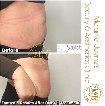Cell Sculpt Fat Loss Results.JPEG