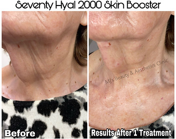 Seventy Hyaluron 2000 Skin Booster.JPEG