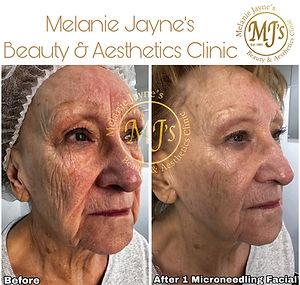 Micro Needling Results.JPEG