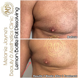Pseudo-Gynecomastia (Man Boobs).JPEG
