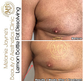 before and after lemon bottle fat dissolving arms Neuro Optimizer - 120 Capsules - Jarrow Formulas main image 1