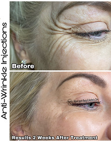 Botox Eye Lift.JPEG