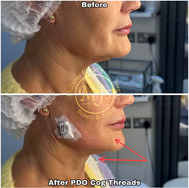 Cog Thread Lift.JPEG