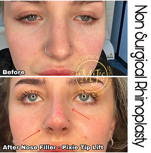Nose Filler - Pixie Tip Lift.JPEG