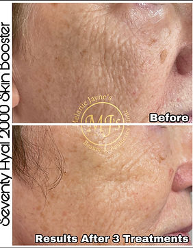 Seventy Hyal Skin Booster.jpg