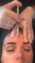 mesotherapy nappage
