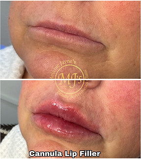 Cannula Lip Filler.JPEG