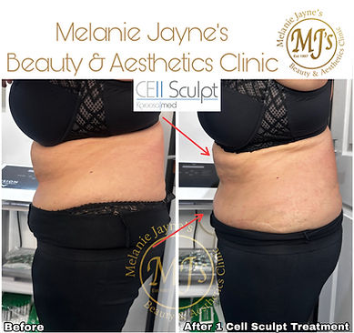 Cavitation Fat Loss Treatment.JPEG