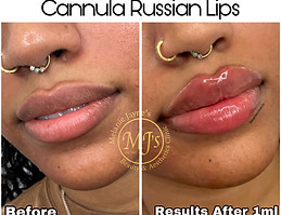 Cannula Russian Lips.JPEG