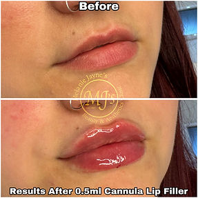 3Cannula Lip Filler.JPEG