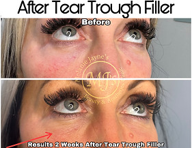 Tear Trough Filler.JPEG