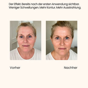 Vorher-Nachher nach einer Gua-Sha-Anwendung nach der Herzlieb-Methode by Clean Beauty Concept – weniger Schwellungen und definiertere Gesichtskonturen.