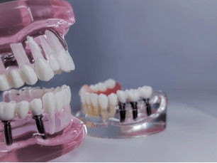 Bridge vs Implant: Which Is Better?