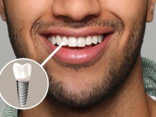 What Are Dental Implants? A Beginner’s Guide | Dentist in Phoenix AZ
