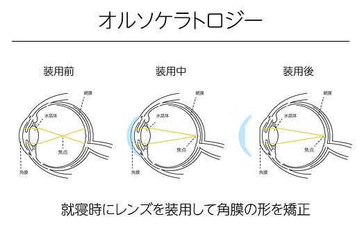 オルソケラトロジー治療