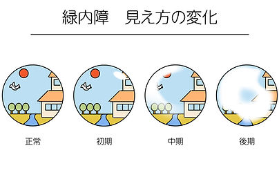 緑内障の見え方の変化