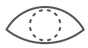 白内障