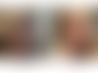 I recently had a lower blepharoplasty to remove undereye bags; this is my journey.
