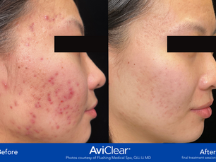 Dealing With Adult Acne: Understanding Your Treatment Options