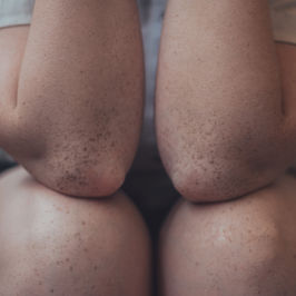 Psoriasis & Autoimmune Disorders