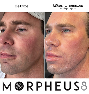 Morpheus8 in orlando florida before and after