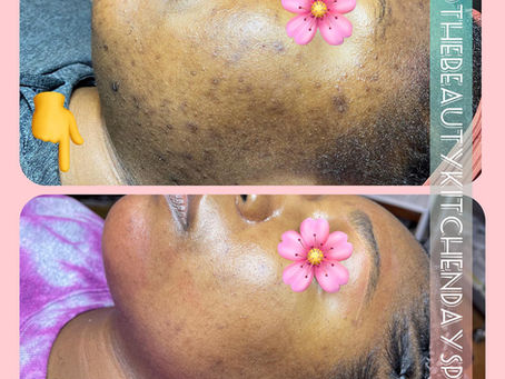Hyperpigmentation and Dark Spots: Understanding, Preventing, and Treatment