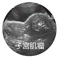 子宮肌瘤.png