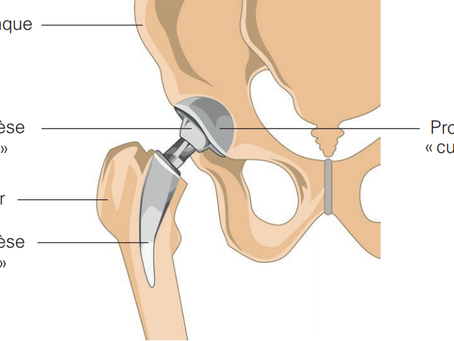 Prothèse totale de hanche : chirurgie, traitement et rééducation complète