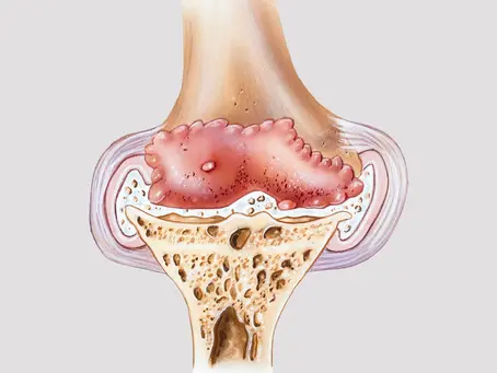 L'arthrose : tout savoir sur cette maladie dégénérative, ses symptômes et traitements