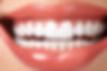 Smile Desined teeth of a model.jpg