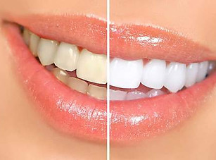 whitening_large_718b4004-199b-49ad-9866-