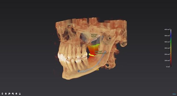 CBCT cone beam CT airway imaging scan showing airway dimensions at Better Sleep Oklahoma in Oklahoma City