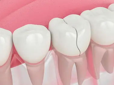 cracked-tooth.webp