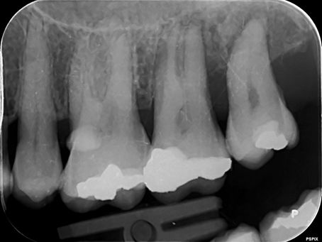 A periodontal abscess is a dental emergency