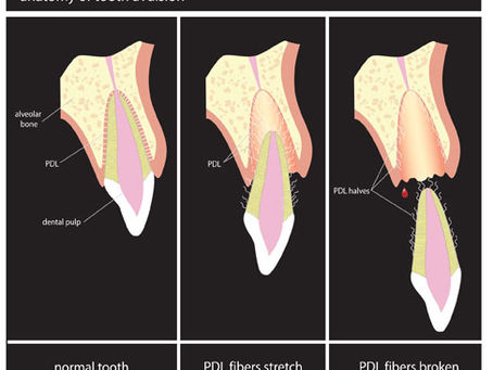 Tooth Reimplantation: Re-inserting an avulsed tooth in the mouth.