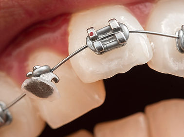 broken braces.jpg